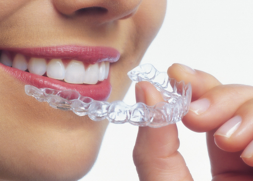 Paciente colocando alineador Invisalign para tratamiento de Ortodoncia Invisible