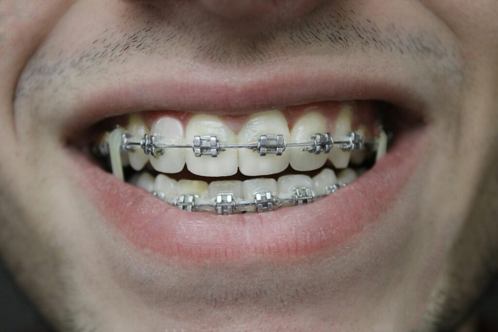 Paciente adulto con brackets metálicos en tratamiento de ortodoncia dental