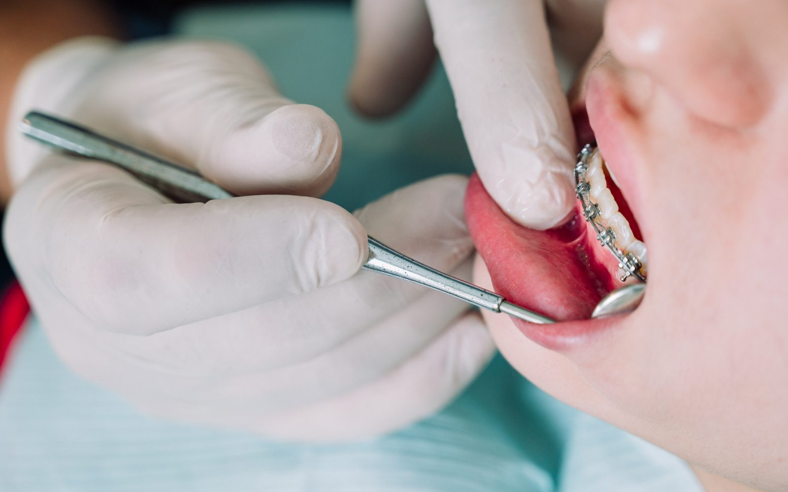 Revisión dental de ortodoncia con brackets metálicos por especialista